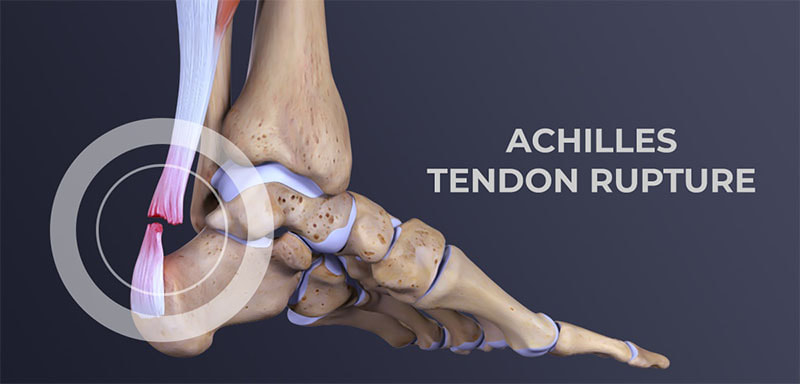 Achilles tendon rupture - treatment, surgery - The Neo Orthopaedic Clinic
